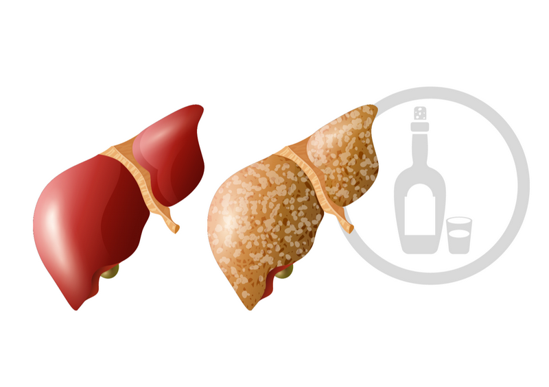 Alimentacion para higado graso no alcoholico